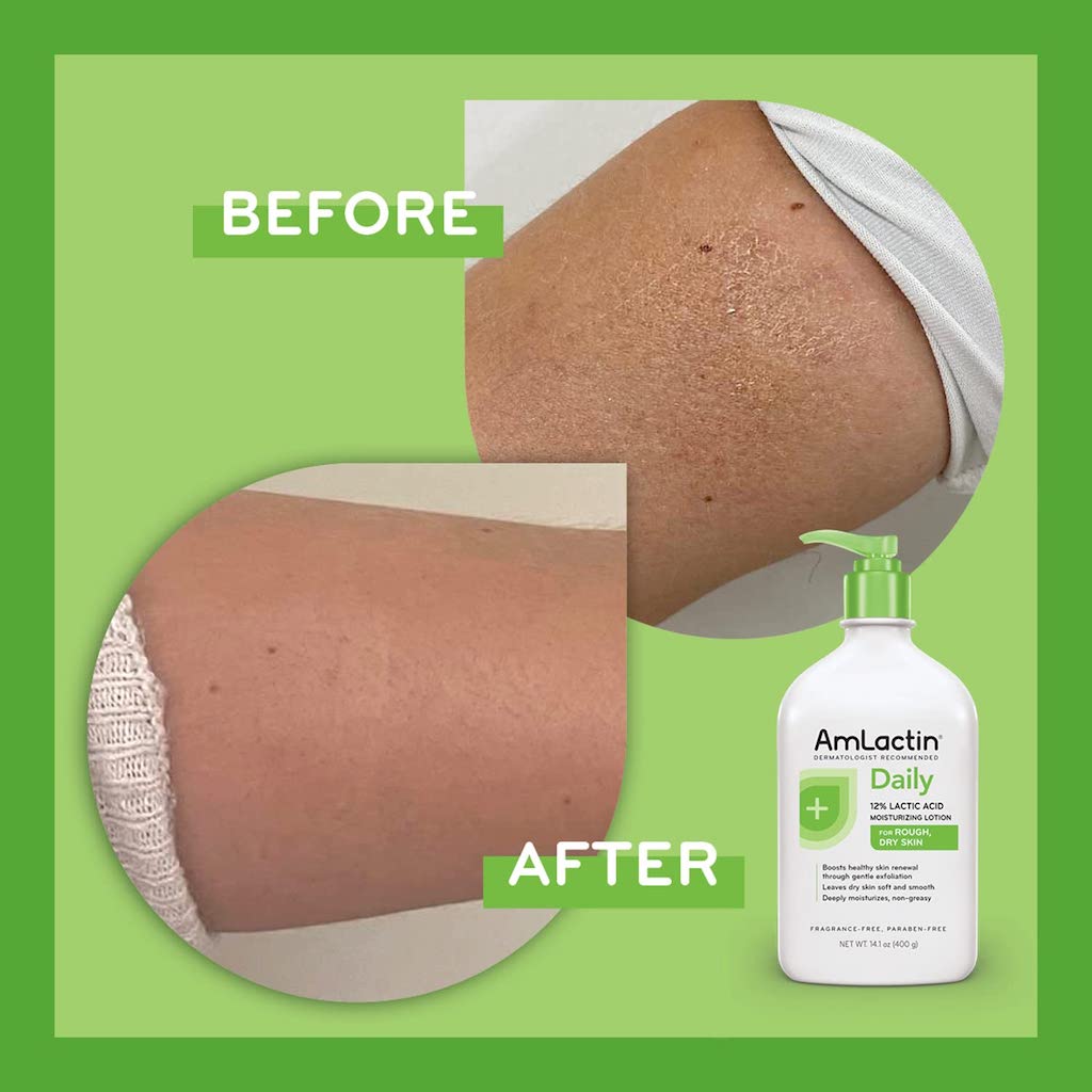 AMLACTIN DAILY MOISTURIZING LOTION WITH 12% LACTIC ACID